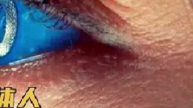 你体内还存在另一个自己？揭开神秘的“嵌合体”人（下）