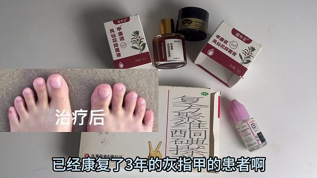灰指甲产品大测评！看看有没有你用的？