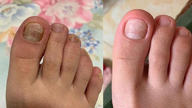 灰指甲抑菌产品怎么选？过来人分享2款，用过的灰指甲早好了！
