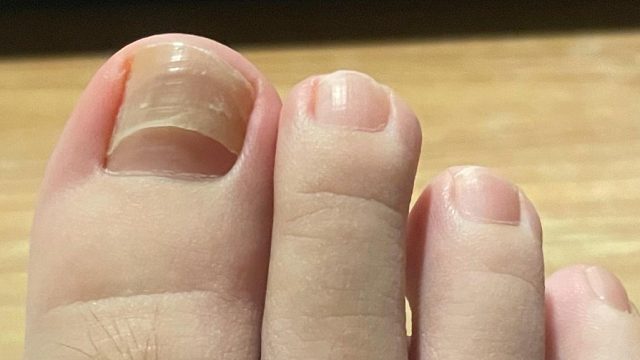 得了灰指甲怎么治？学会这招，坏甲唰唰往下掉！