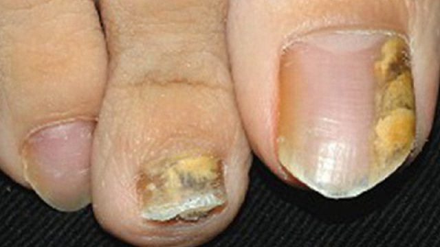 灰指甲终于好了！血泪经验分享！