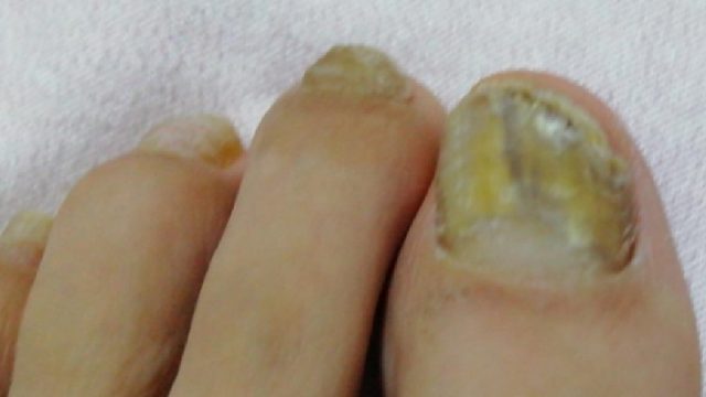 顽固灰指甲一朝根治！方法竟然这么简单？！不用多花一分冤枉钱！