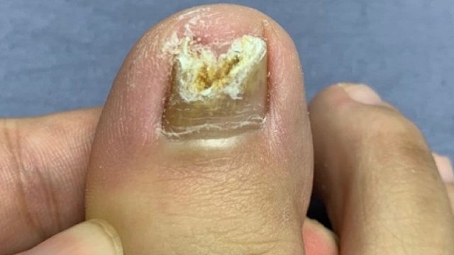 指甲发黄增厚掉碎渣？这是指甲正在遭受真菌侵害！2招教你解决！