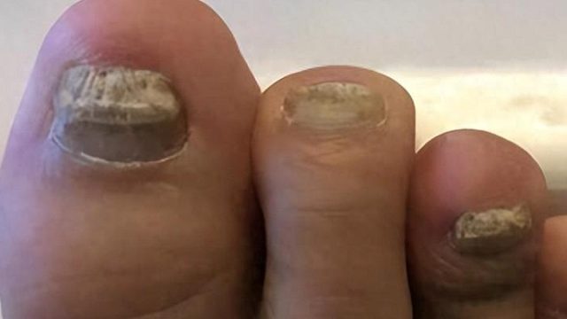 灰指甲用偏方有用吗？真相竟然.......