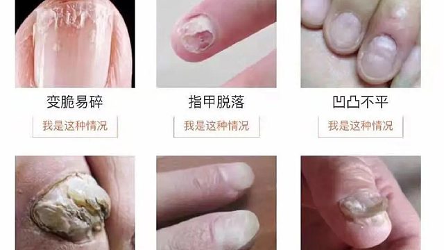 如何判断灰趾甲？灰指甲怎么治疗？