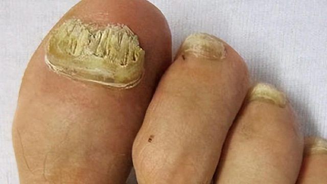 顽固灰指甲还有救！学会这招，1个月坏甲自动脱落！