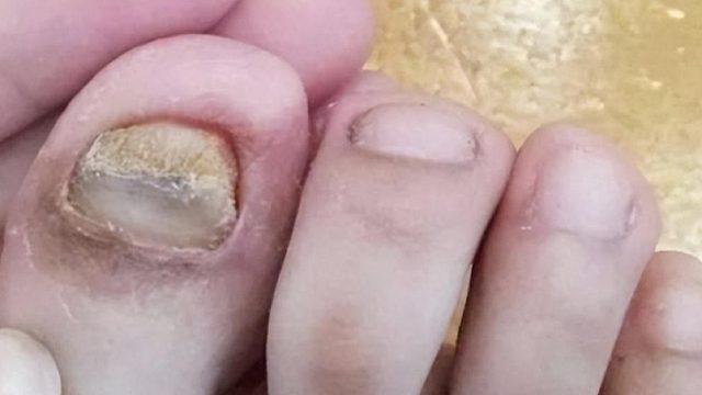 得了灰指甲，还有救吗？过来人康复经验你分享！