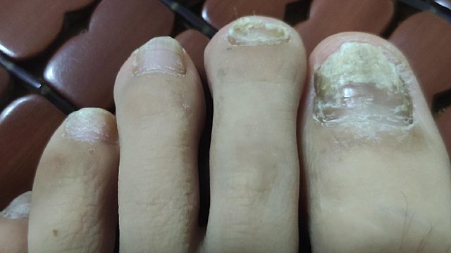 灰指甲进入高发期怎么治！康复者分享2招，应对灰指甲真灵！