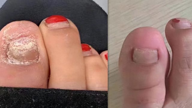 祛灰产品怎么选？康复者分享3款自用！安全有效还便宜！