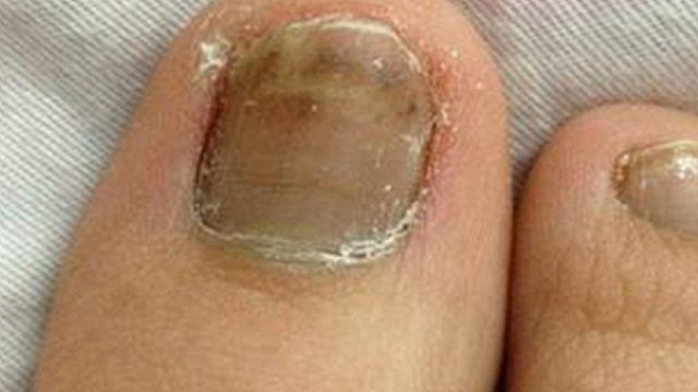 天一热灰指甲就复发？！学会这三个解决办法！一键除菌不反复！