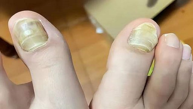 教你不花冤枉钱在家治好灰指甲！每天3分钟，泛黄增厚坏甲自己掉