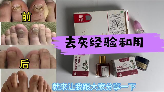 过来人经验分享！其实在家就能轻松摆脱顽固灰指甲！
