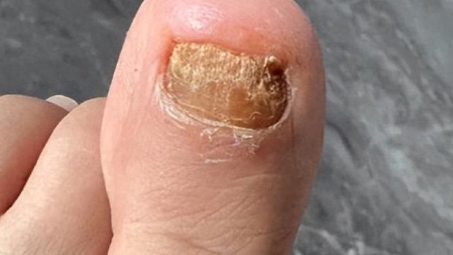 天热灰趾甲又复发？三个国货祛灰好物快用！杀菌修复不反灰！