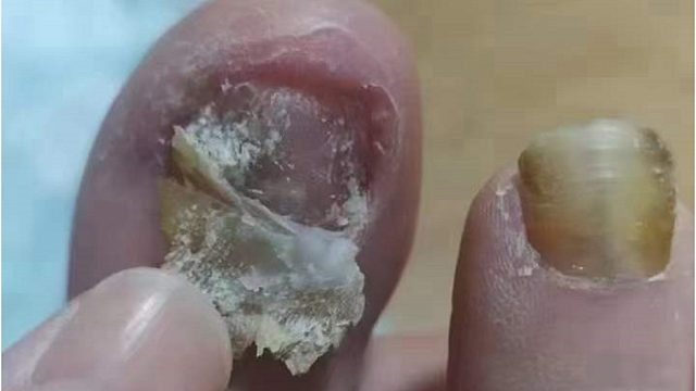 指甲增厚发黄还空甲怎么办？学会这4招，在家跟它说拜拜！