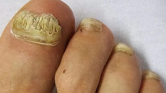 灰指甲详细治疗经验分享！（坚持版）