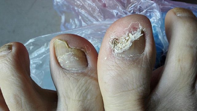 灰指甲到底怎么治？皮肤科工作三年，说点真话！