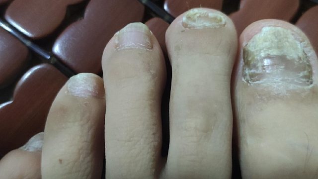 灰指甲反复发作太难治？医学生给你支几招！杀菌修复不反灰！