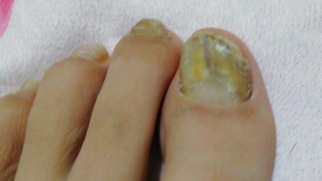 得了灰指甲怎么治？学会这3招，真菌见你绕着走！30坏甲唰唰掉！