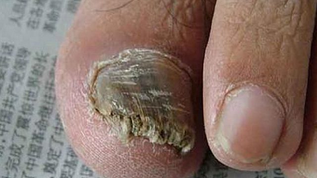 灰指甲泛黄增厚，反复治不好？这个步骤跟着做，在家几毛钱搞定！