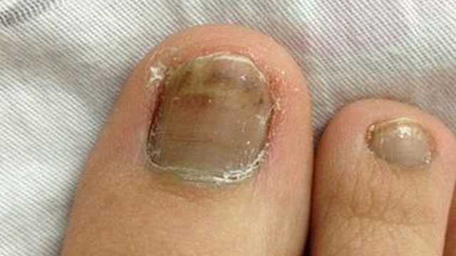 杀菌祛灰不反复！这个秘籍还有人不知道？简直是灰指甲患者福音