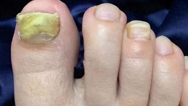 灰指甲颜色发黄还增厚？小心传染给家人！3个常用物品教你解决！