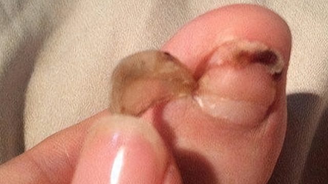 为什么想要彻底治好灰指甲，一定要让原本的病甲软化脱落？