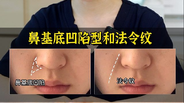 鼻基底凹陷型法令纹如何改善？