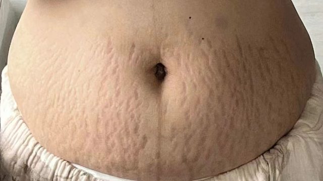 产后怎么去妊娠纹？学会这个步骤，红白纹分分钟消灭！