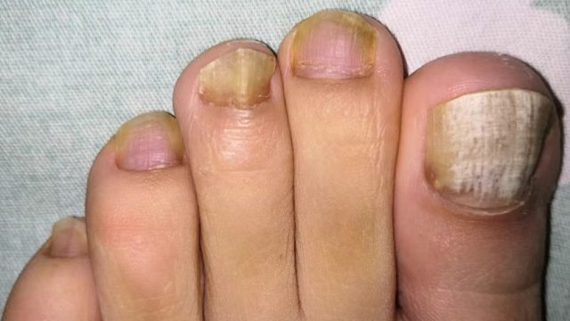 灰指甲如何用药？这3个宝藏国货还有人不知道？坏甲说没就没！