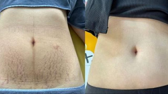 妊娠纹3招淡化！没想到过来人的方法这么好！妊娠纹宝妈必看！