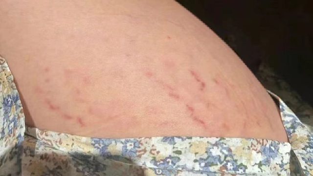 肥胖纹3年成功去除！这个操作步骤封神了！皮肤分分钟光滑细腻！