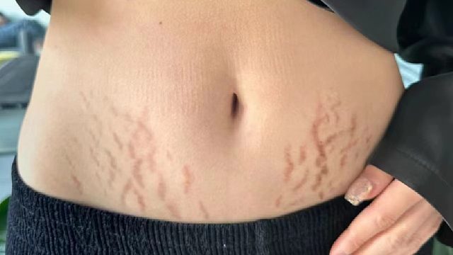紫红色妊娠纹怎么淡？4个步骤坚持30天，皮肤重回光滑紧致！