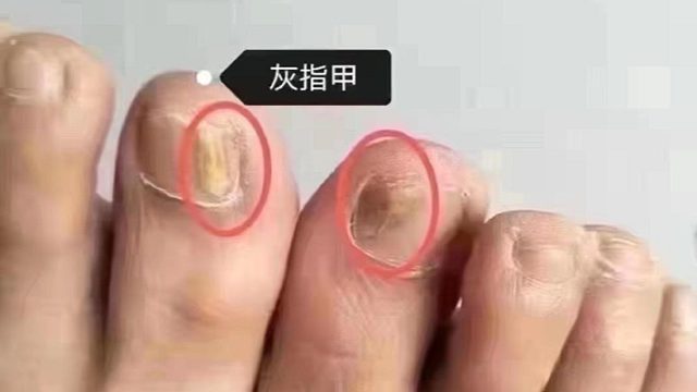 立秋后是摆脱灰指甲的最佳时机！学会这招，真菌再也不来扰！