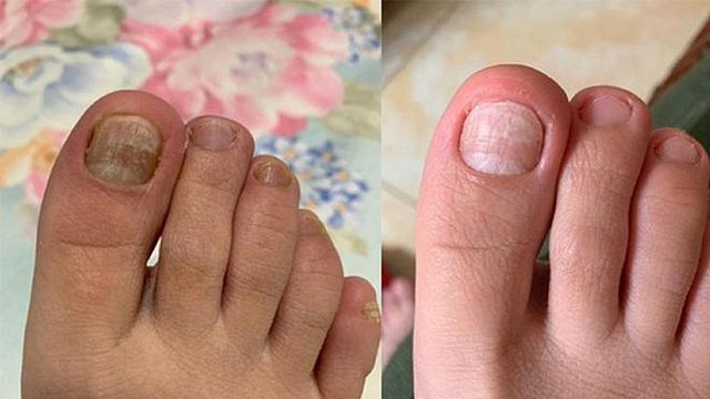 灰指甲在家解决！方法分享！