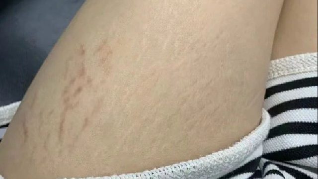 肥胖纹祛纹干货分享！皮肤光滑嫩到不行！学会再不用去美容院！