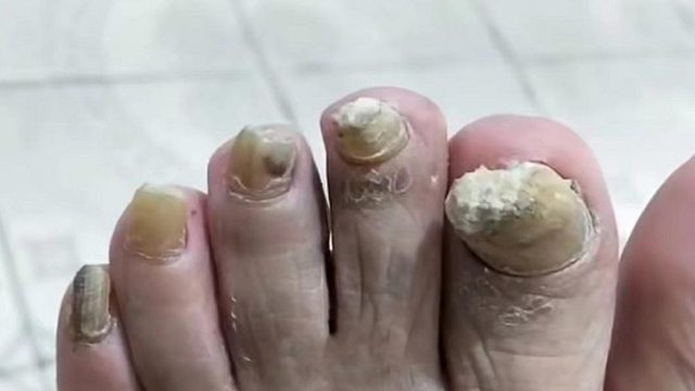 顽固灰指甲怎么治？康复者教你几招，不多花一分冤枉钱在家根治！