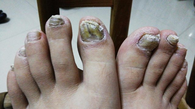 灰指甲会传染给家里小孩吗?要怎么才能避免传染，彻底治好？