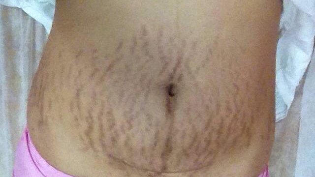 妊娠纹坑坑洼洼还有救吗？过来人两招教你淡化！皮肤秒变牛奶肌！