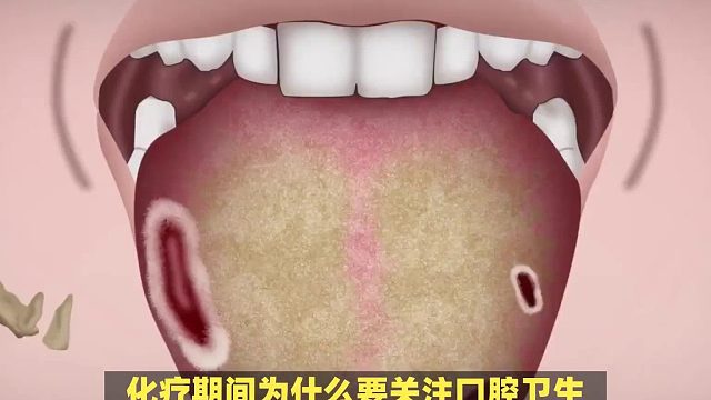化疗期间为什么要关注口腔卫生