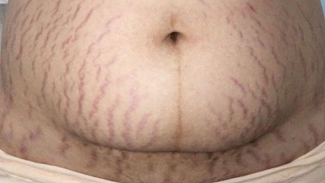 宝妈必看！简单几招妊娠纹在家淡化！早知道谁还去美容院啊！