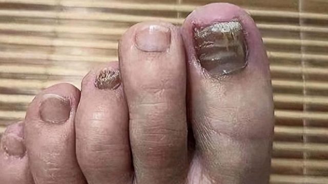 教你不花一分冤枉钱解决灰指甲！一个月坏甲唰唰掉！早看早受益！