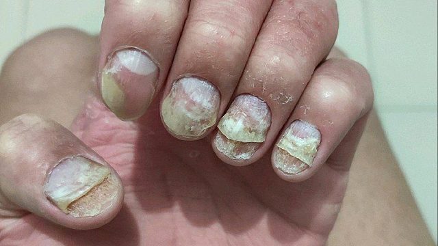 手上的灰指甲怎么治？(经验版)