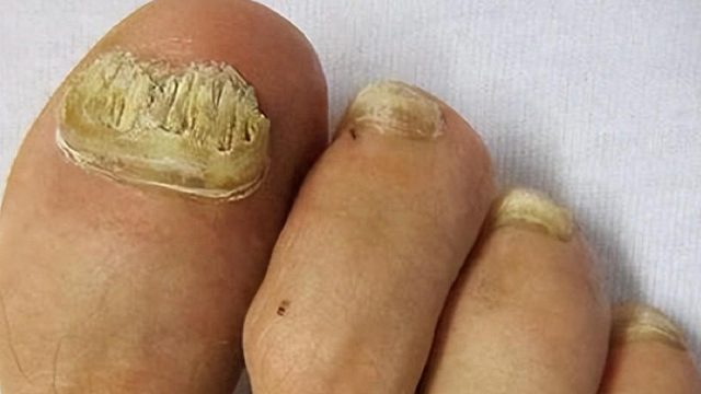 顽固灰指甲反复无法根治？学会这3招，在家也能轻松根治不反复！