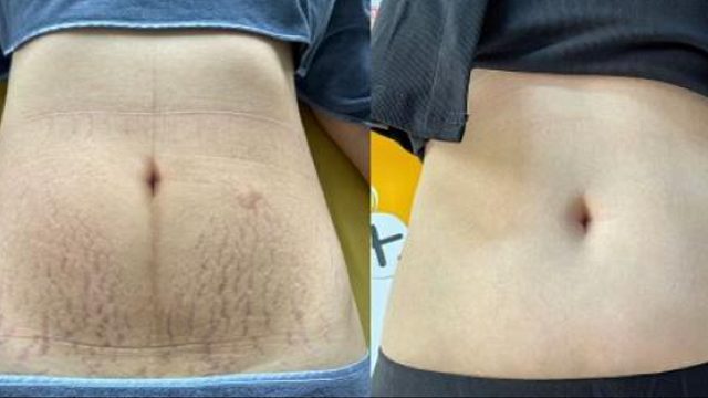 劝麻了！妊娠纹这么修复太牛了！皮肤秒变光滑牛奶肌！