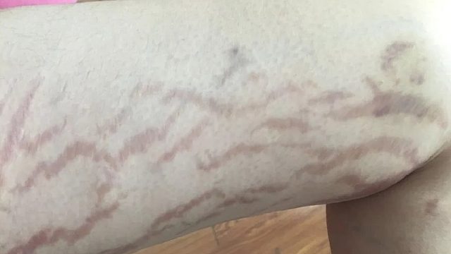 瘦太快竟然也会长肥胖纹！这几个淡纹秘诀你可能还不知道！速看！