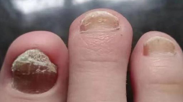 真菌感染的灰指甲一治一个准！每天成本几毛钱！学会终身受益！