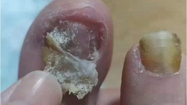 灰指甲治疗的8个【Q&A】，终于知道灰指甲该怎么治了！
