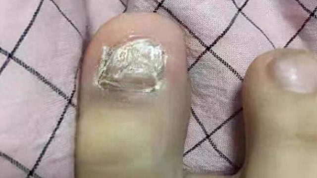 真菌感染的灰指甲怎么治？学会这几招！ 指甲瞬间亮洁如新！