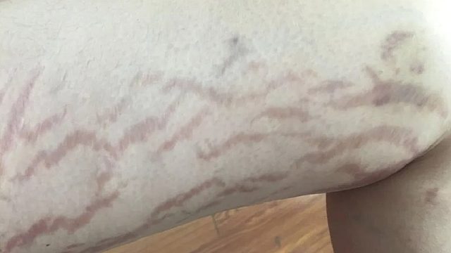 皮肤开裂长肥胖纹？别慌！过来人教你在家解决！皮肤光滑又细腻！