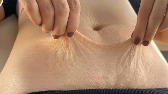 妊娠纹宝妈必看！过来人祛纹秘籍分享！简单4招胜过激光百次！